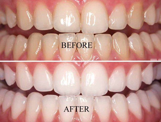 Teeth Whitening Treatment Near Me in Kumbakonam – Nalamm Dental Cosmetiks