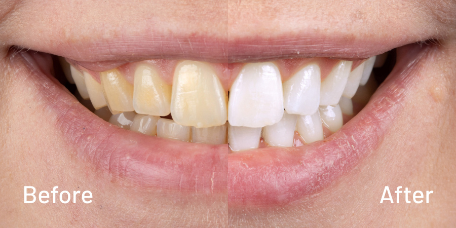 Teeth Whitening Treatment Near Me in Kumbakonam – Nalamm Dental Cosmetiks