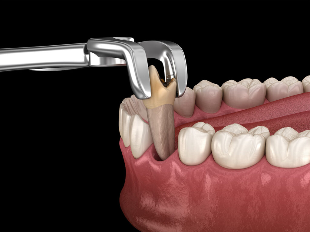 Affordable Tooth Removal Treatments in Kumbakonam – Nalamm Dental Cosmetiks