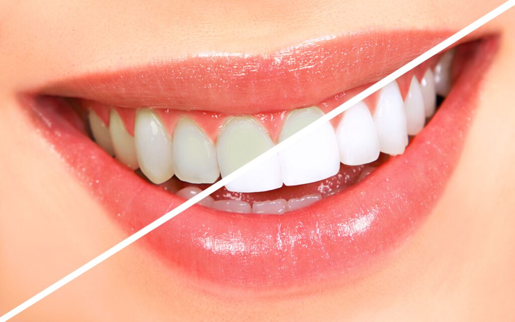 Affordable professional teeth whitening services - Nalamm Dental Cosmetiks , Kumbakonam