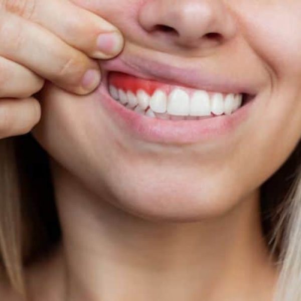 "Gum Contouring Side Effects & Recovery – Expert Care at Nalamm Dental Cosmetiks"