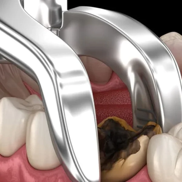 "Painless Wisdom Teeth Removal in Kumbakonam – Trust Nalamm Dental Cosmetiks for Expert Care"