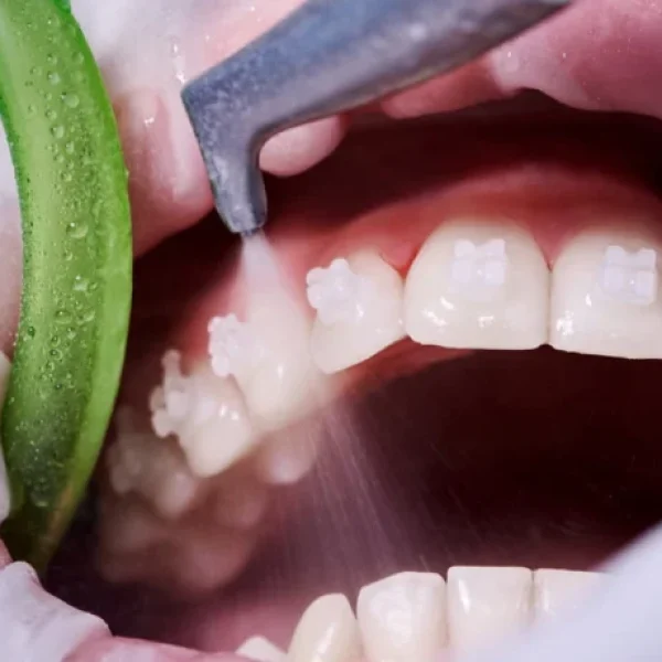 Advanced Airpolishing Treatments in Kumbakonam – Nalamm Dental Cosmetiks