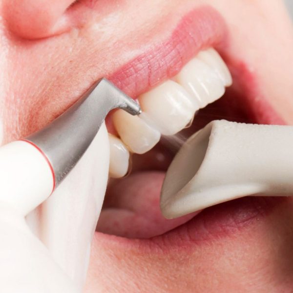 Advanced Airpolishing Treatments in Kumbakonam – Nalamm Dental Cosmetiks