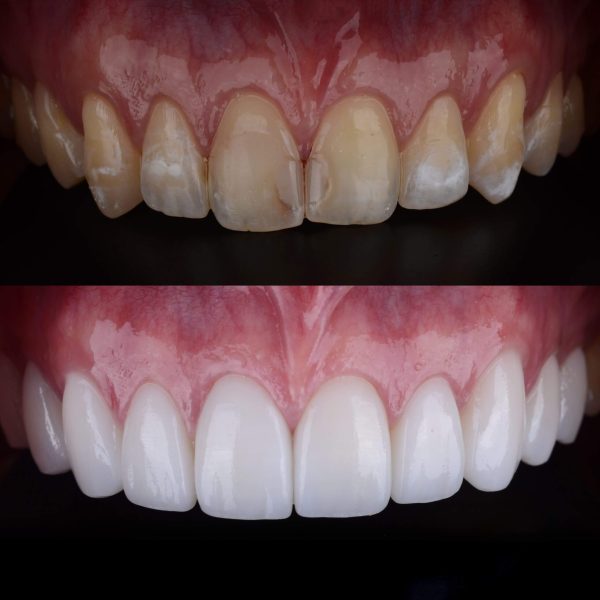 Composite veneers treatments in Kumbakonam at Nalamm Dental Cosmetiks for natural-looking smile correction with minimal tooth preparation.