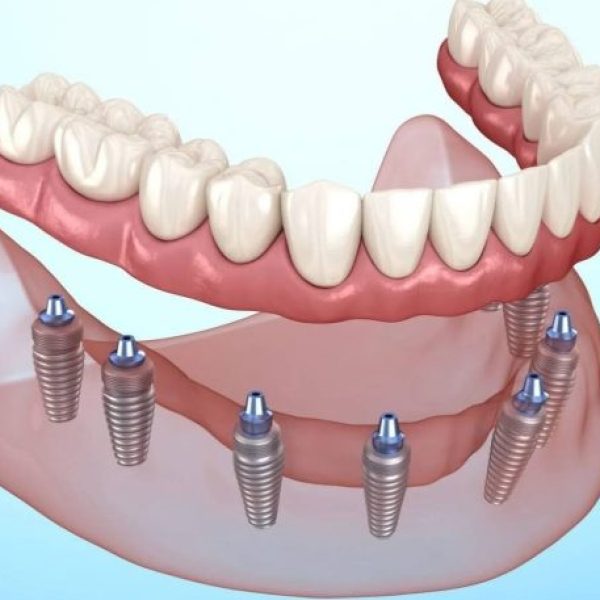 Dental Implant Clinic in Kumbakonam – Nalamm Dental Cosmetiks