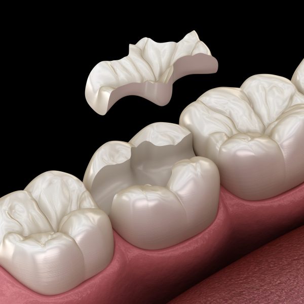 Dental Inlay Cost in Kumbakonam | Tooth Inlay Treatment – Nalamm Dental Cosmetiks