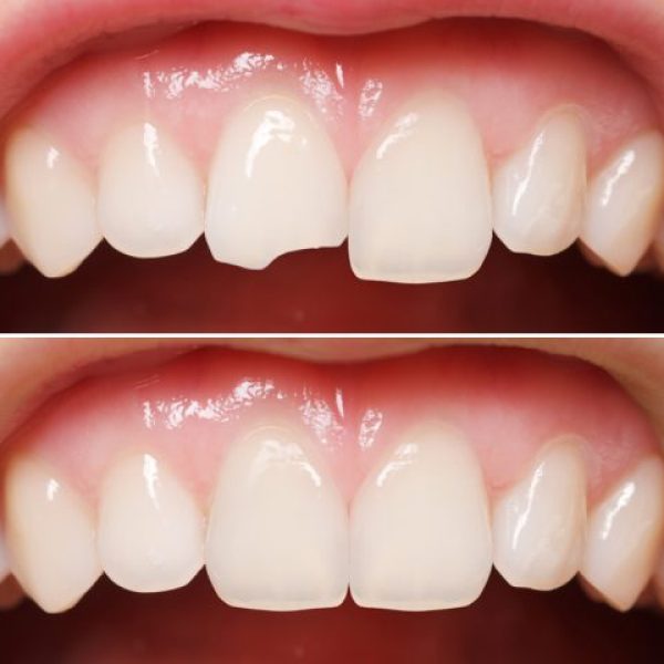 Fractured Tooth Correction Treatments in Kumbakonam – Nalamm Dental Cosmetiks