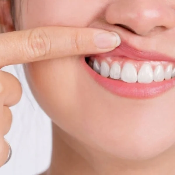 Heal with confidence and transform your smile—expert gum contouring recovery care at Nalamm Dental Cosmetiks.