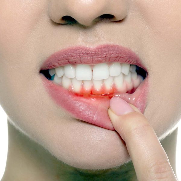 "From Treatment to Transformation: Gum Contouring Recovery – Nalamm Dental Cosmetiks"