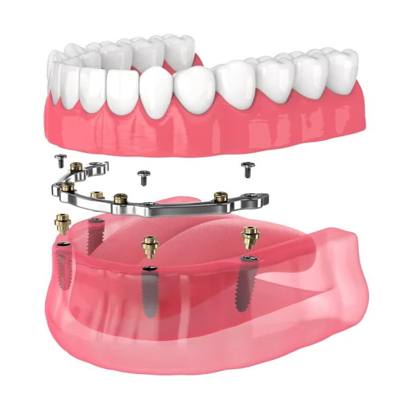 Price of Full Mouth Dental Implants in Kumbakonam | Nalamm Dental Cosmetiks