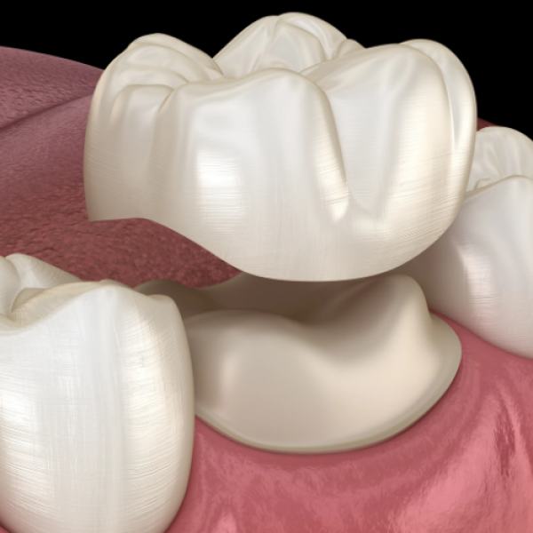 "Restore Your Smile with Confidence: Moral Crowns at Nalamm Dental Cosmetiks, Kumbakonam"