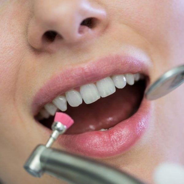 "Say goodbye to plaque and stains! Experience expert scaling and polishing of teeth at Nalamm Dental Cosmetiks – Kumbakonam’s trusted dental care destination."