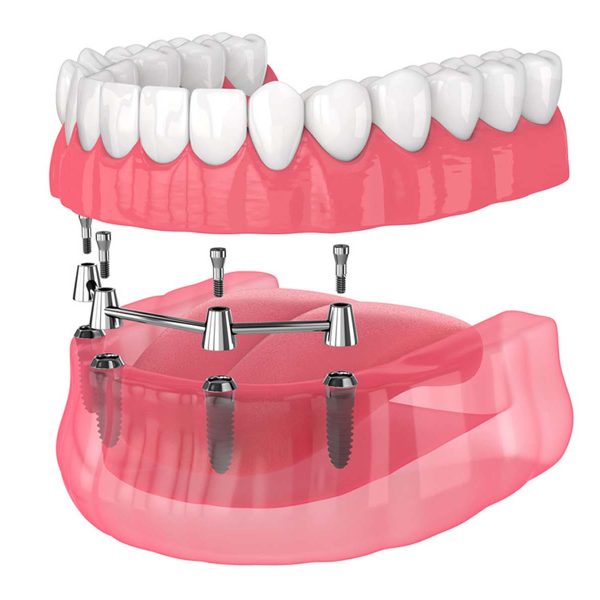 "Smile Reimagined: Dental Prosthesis – Nalamm Dental Cosmetiks in Kumbakonam Leads the Way"