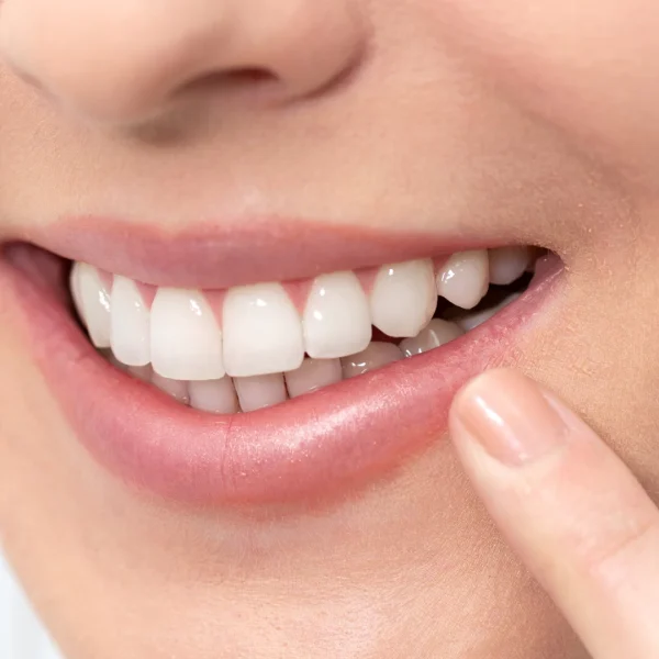 "Strengthen Your Smile with Expert Fluoride Treatment at Nalamm Dental Cosmetiks – Simple, Safe & Scientifically Proven!"