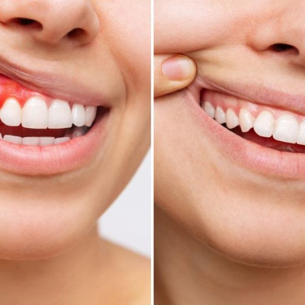 Transform Your Smile: Gum Reshaping Cost & Treatment at Nalamm Dental Cosmetiks in Kumbakonam