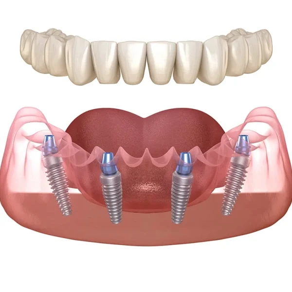 Dental Implant Clinic – Nalamm Dental Cosmetiks in Kumbakonam: Where Technology Meets Trust