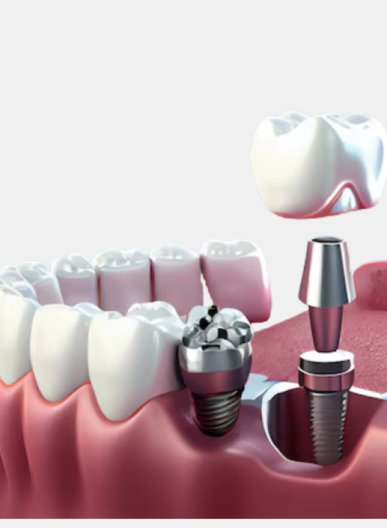 Who Can Get Dental Implants? Key Health Factors Who Can Get Dental Implants? Key Health Factors